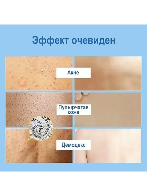 Очищающий гель для душа против прыщей, вариант, фото 4